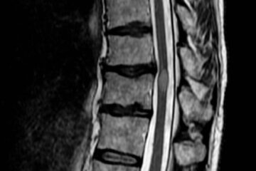 transverse myelitis